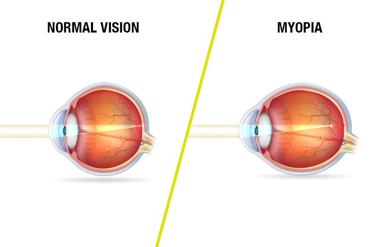 Bollé Safety  VISUAL IMPAIRMENT